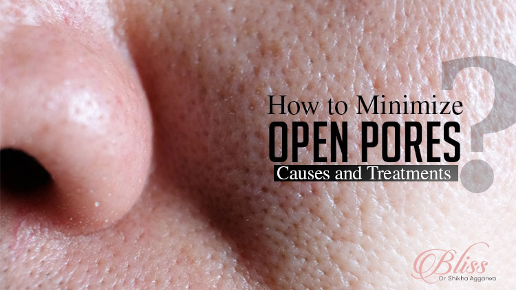 How to Minimize Open Pores: Causes and Treatments