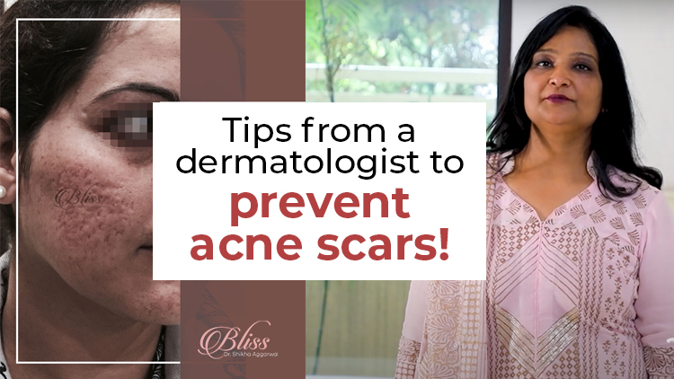 Tips From A Dermatologist To Prevent Acne Scars