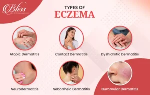 Types of eczema treatments in Ludhiana - Atopic dermatitis, Contact dermatitis, Dyshidrotic eczema, Nummular eczema and etc.